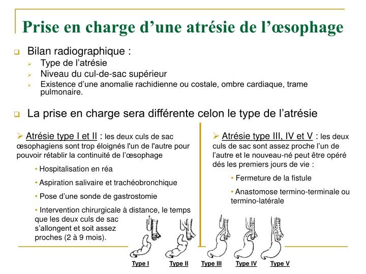 Atresie De Loesophage Esperance De Vie PPT - L’atrésie de l’œsophage PowerPoint Presentation - ID:4083979