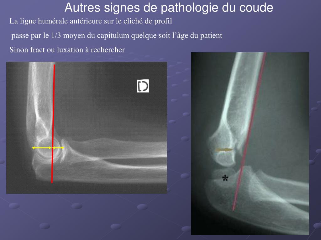 PPT - ANATOMIE RADIOLOGIQUE DU COUDE PowerPoint Presentation, free download  - ID:4084263