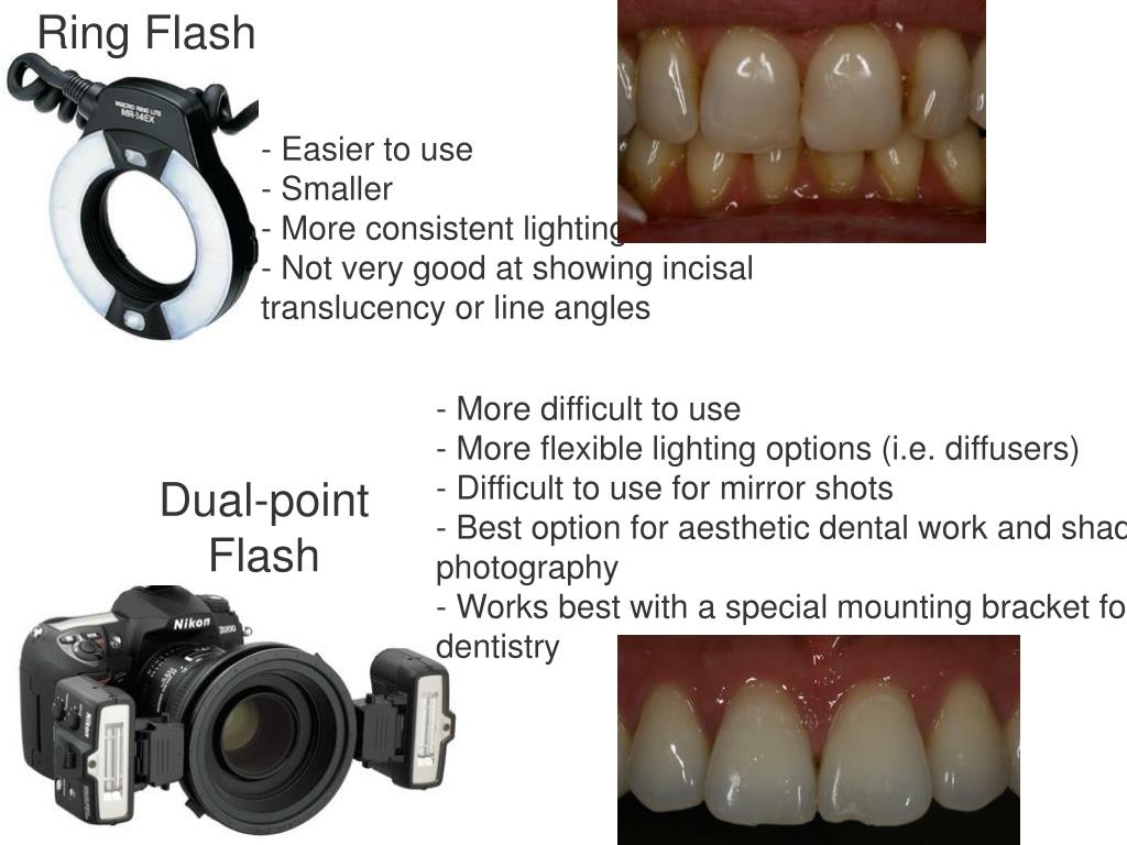 MF-R76S+ DENTAL RING FLASH - SONY in Dental Photography - DentalTV