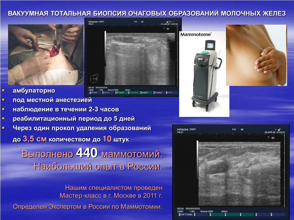 Биопсия Новообразования Кожи Цена К31