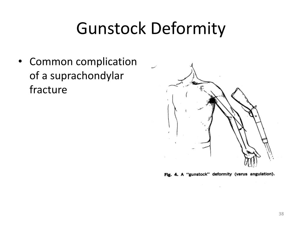 PPT Musculosekeltal Diseases and Disorders Elbow and Forearm