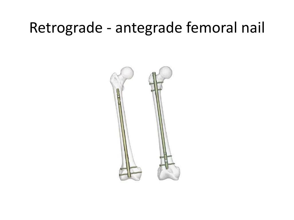 Locking retrograde nail, non-locking retrograde nail and plate fixation in  the treatment of distal third femoral shaft fractures: radiographic, bone  densitometry and clinical outcomes | Journal of Orthopaedics and  Traumatology | Full