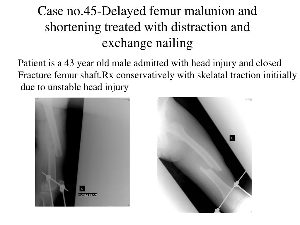 Management of Atypical Femoral Fractures | Oncohema Key