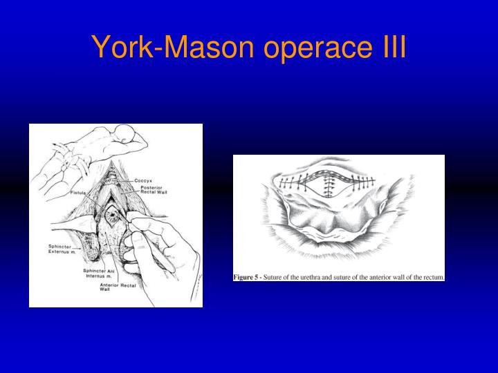 PPT York Mason operace při recidivující rektovezikální píštěli po