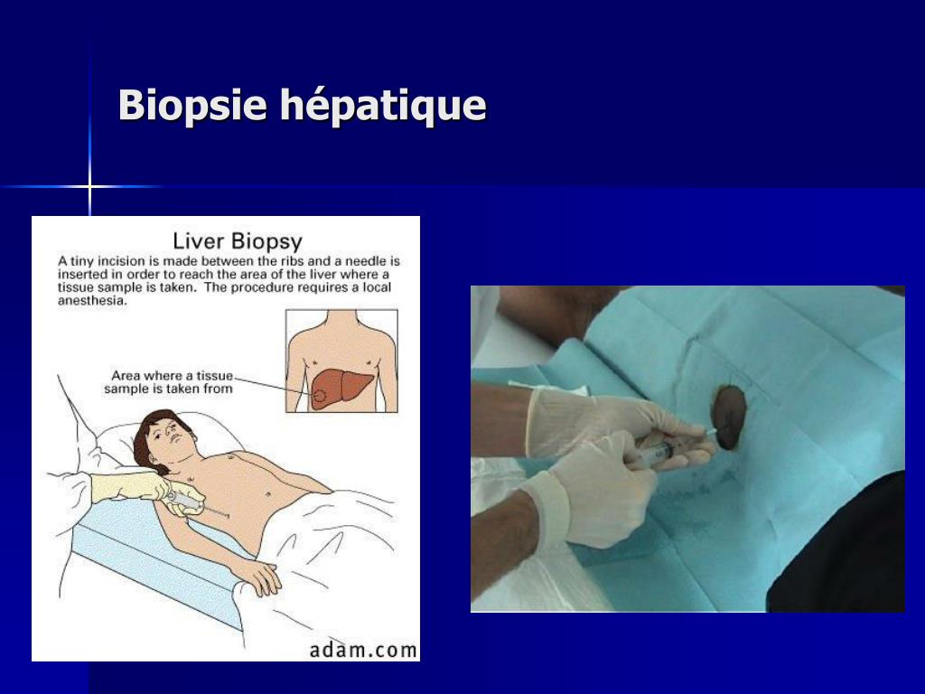 PPT - Cirrhose Hépatique PowerPoint Presentation, Free Download - ID ...