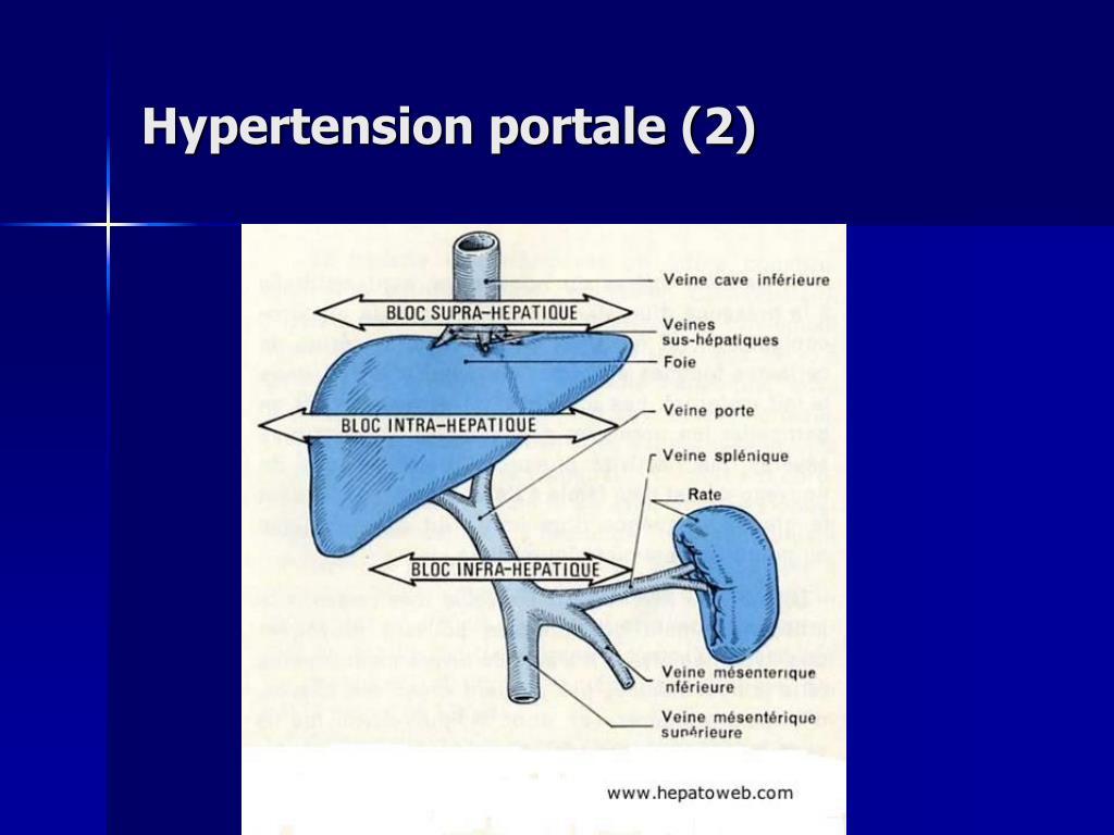 Ppt Cirrhose Hépatique Powerpoint Presentation Free Download Id