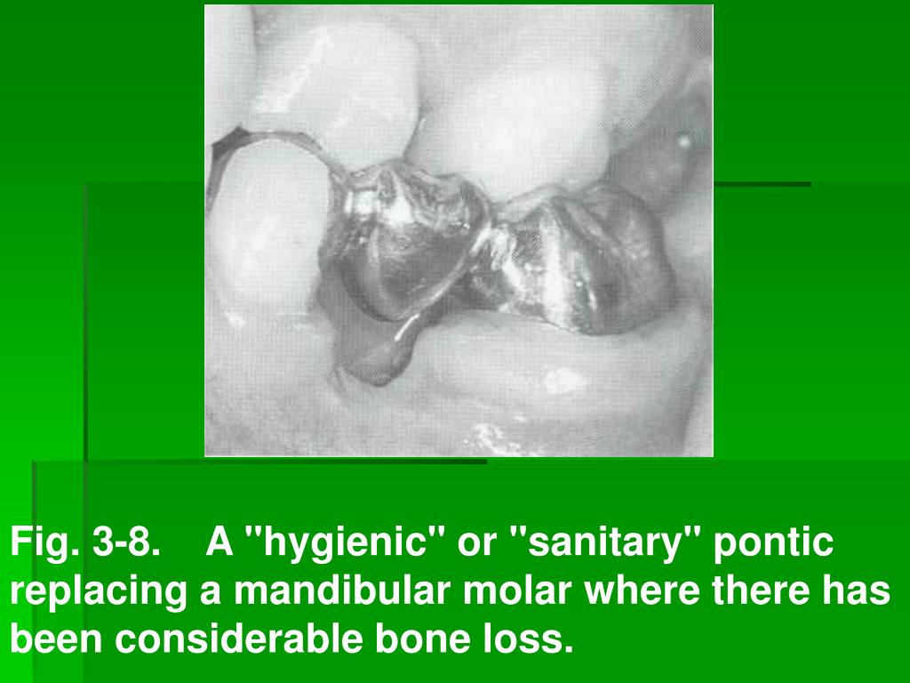 PPT - Dental bridges (pontics). Clinical and technological aspects .  PowerPoint Presentation - ID:4117547