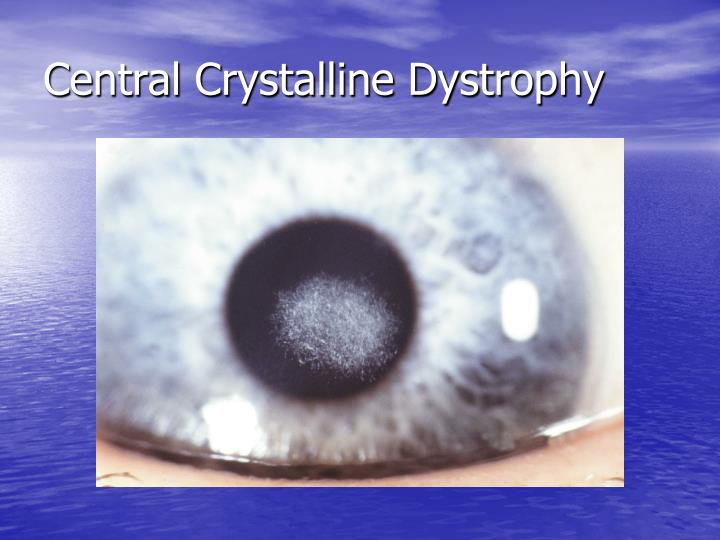 PPT - Corneal Dystrophies and Degenerations PowerPoint Presentation ...