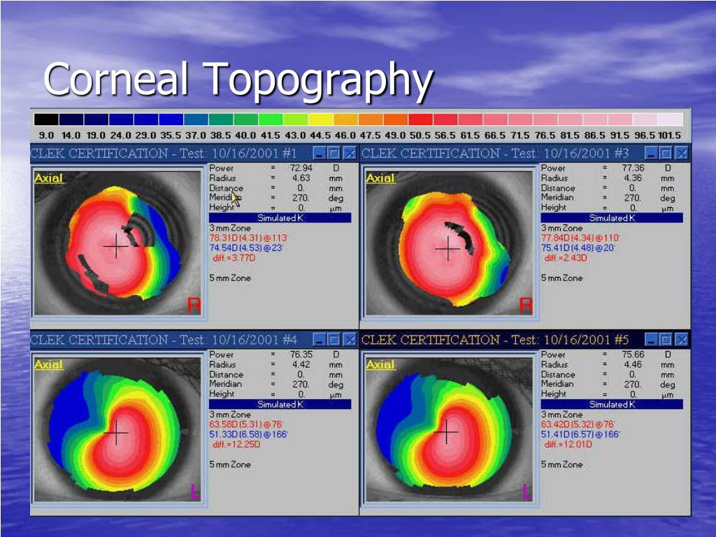 PPT - Corneal Dystrophies And Degenerations PowerPoint Presentation ...