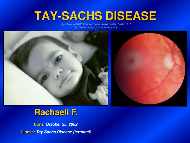 taysachs disease taysachs disease