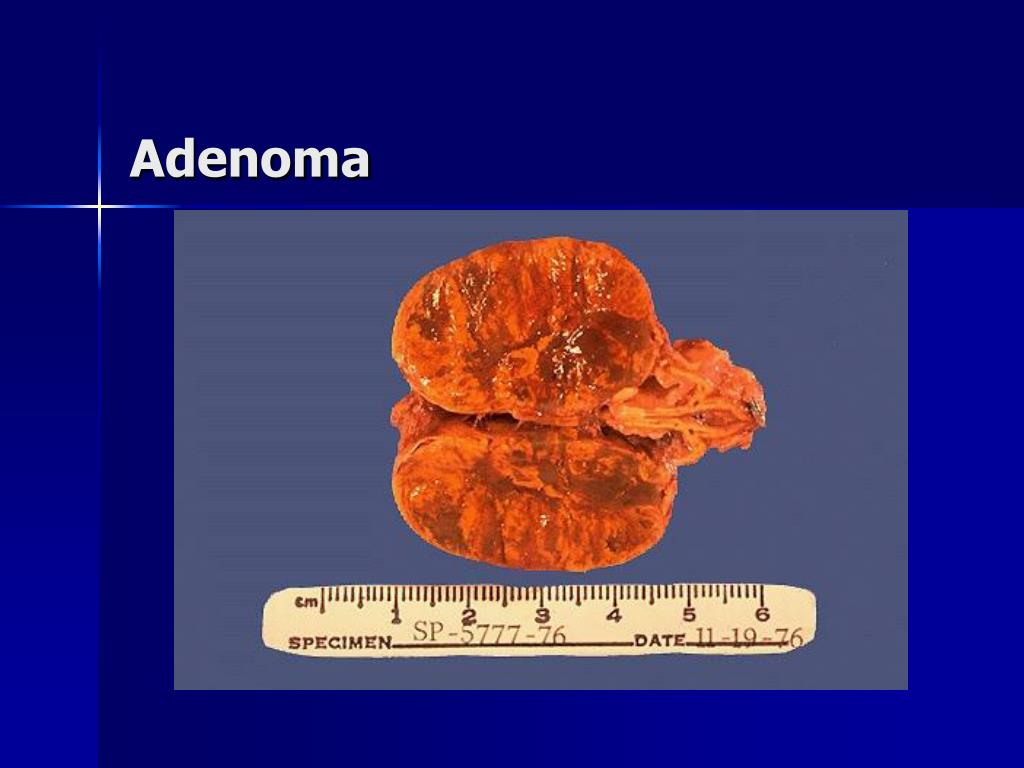 probable adrenal adenoma