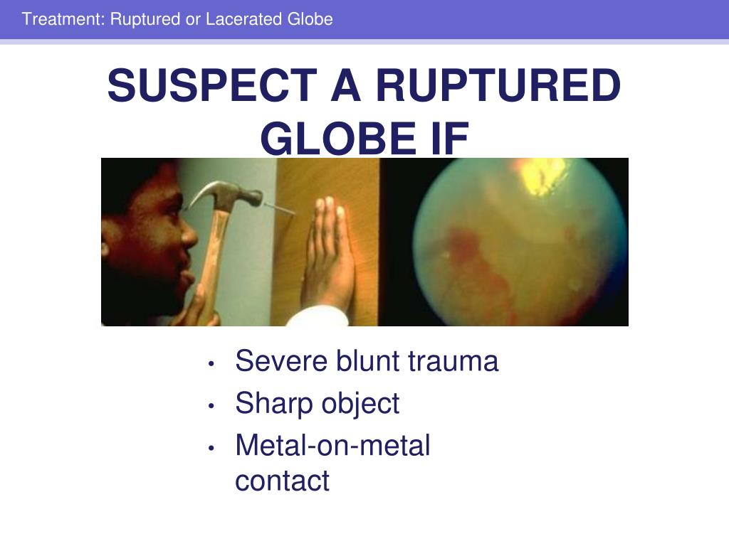 PPT Eye Trauma And Emergencies PowerPoint Presentation Free Download PPT Eye Trauma And Emergencies PowerPoint Presentation Free Download