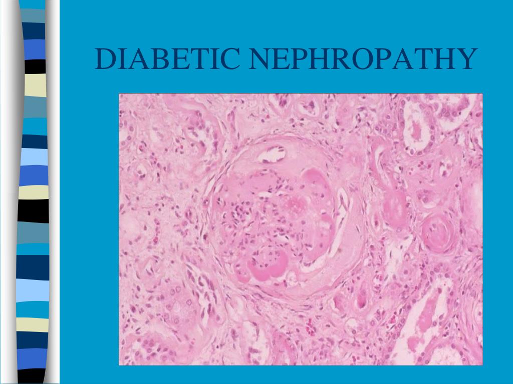 diabetic nephropathy case study ppt