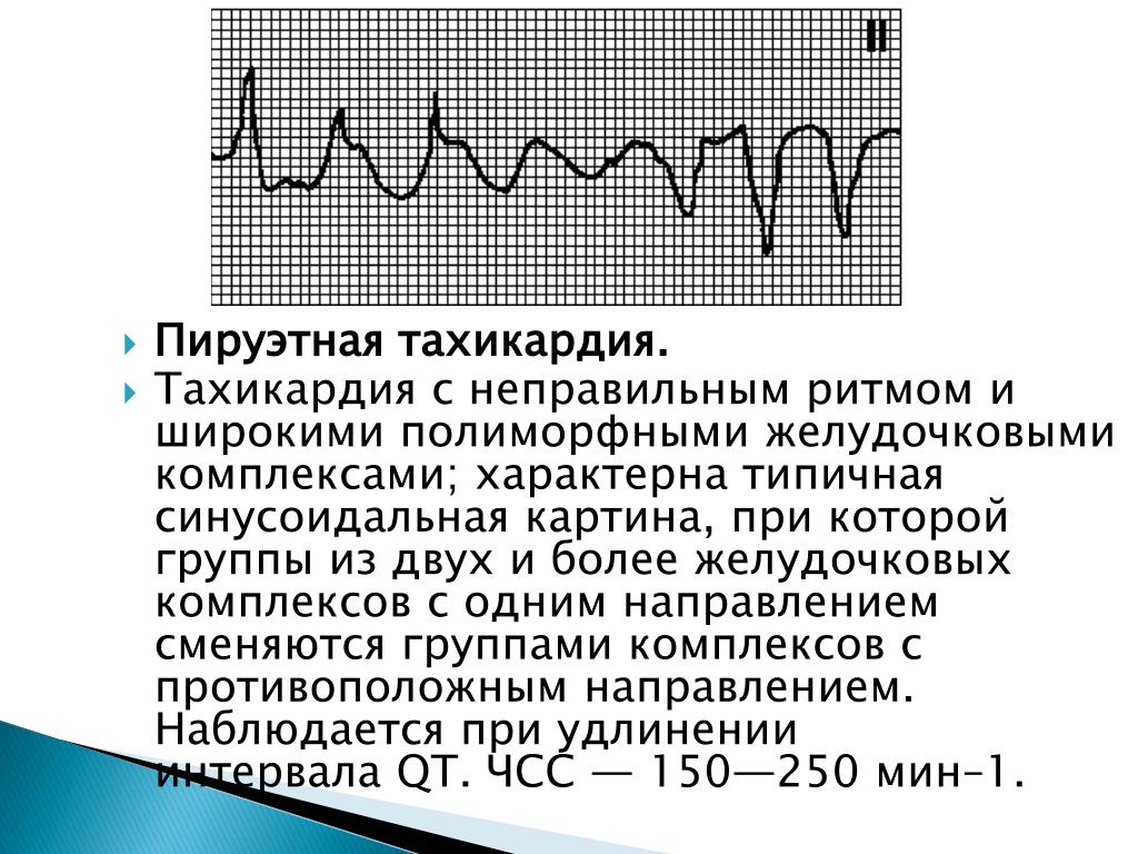 Сильное сердцебиение температура. Полиморфная желудочковая тахикардия ЭКГ. Желудочковая тахикардия Пируэт на ЭКГ. Пируэтная тахикардия ЭКГ. Тахикардия типа Пируэт на ЭКГ.