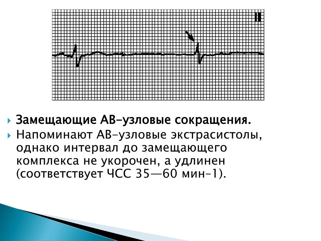 Чсс по экг