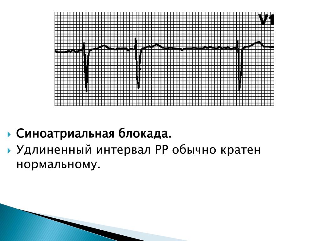 Синоатриальная блокада 1 степени