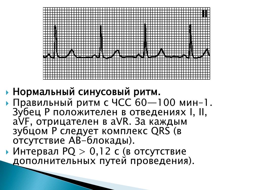 Что значит синусовый ритм сердца на экг. Ритм синусовый ЭКГ чсс73. ЭКГ ритм синусовый ЧСС 676. ЭКГ норма ритм ЧСС. Электрокардиограмма показатели синусовый ритм.