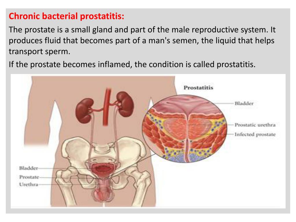 urine of Sperm infection causes