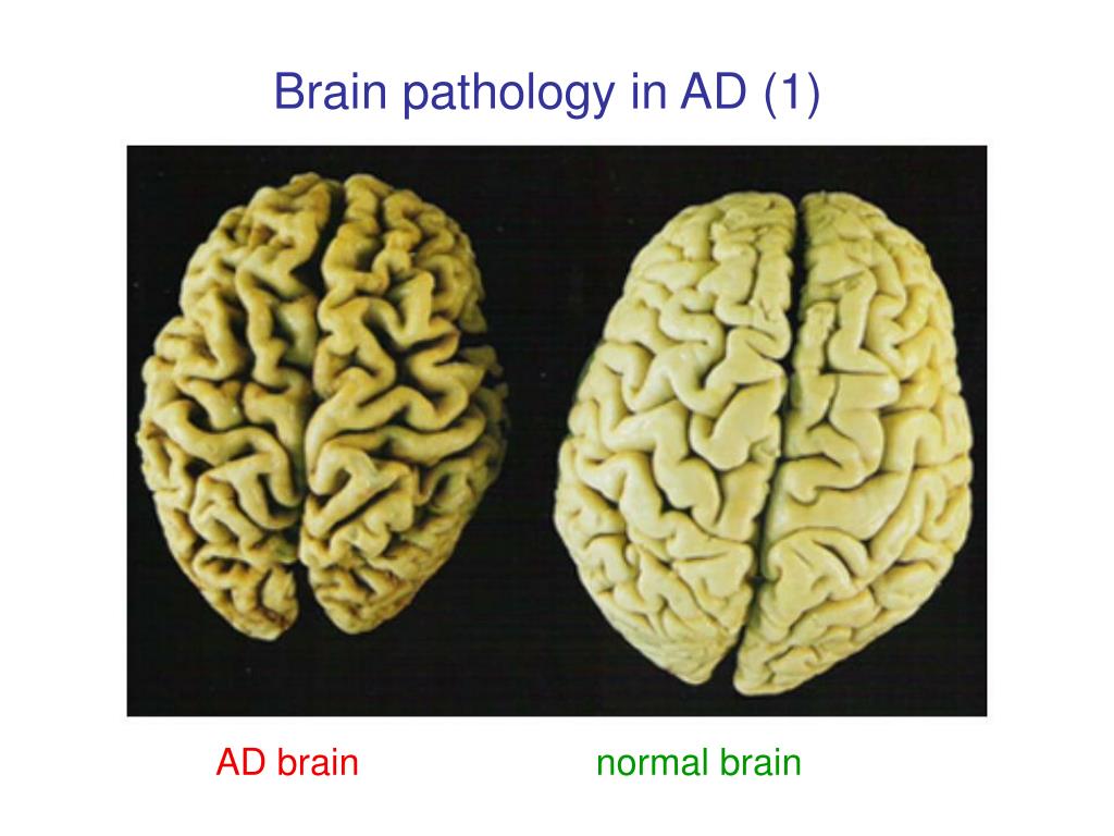 Brain disorders. Старение мозга. Головной мозг старость.