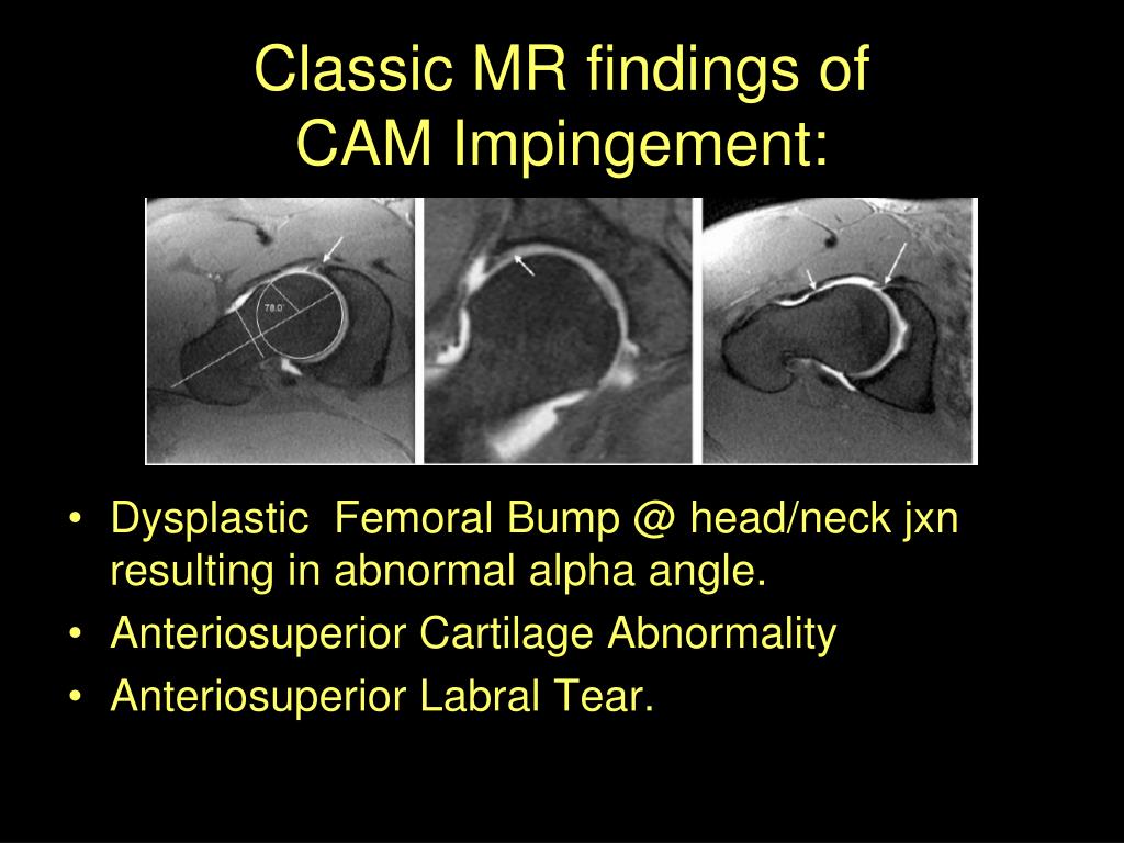 Fai Femoroacetabular Impingement