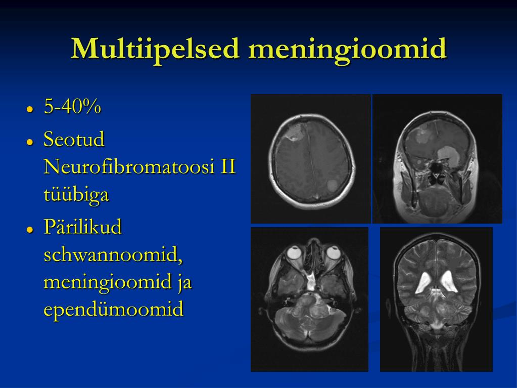 PPT Meningioomid Maria Dementjeva PowerPoint Presentation Free PPT Meningioomid Maria Dementjeva PowerPoint Presentation Free
