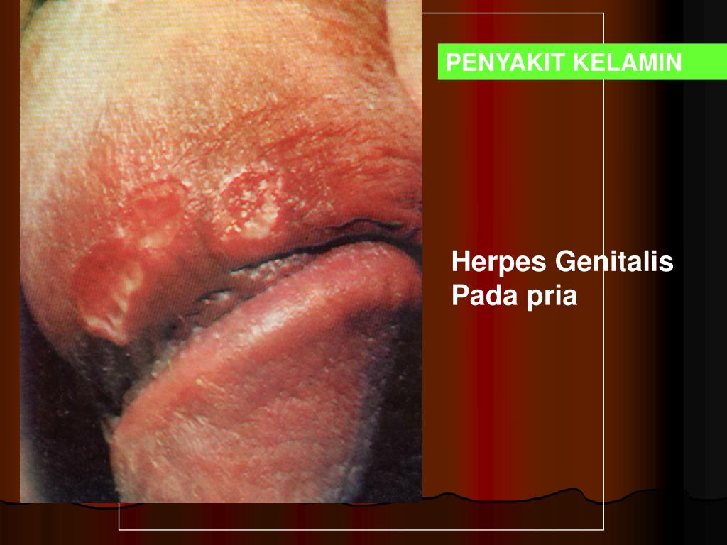 Herpes Genitalis Pada pria.