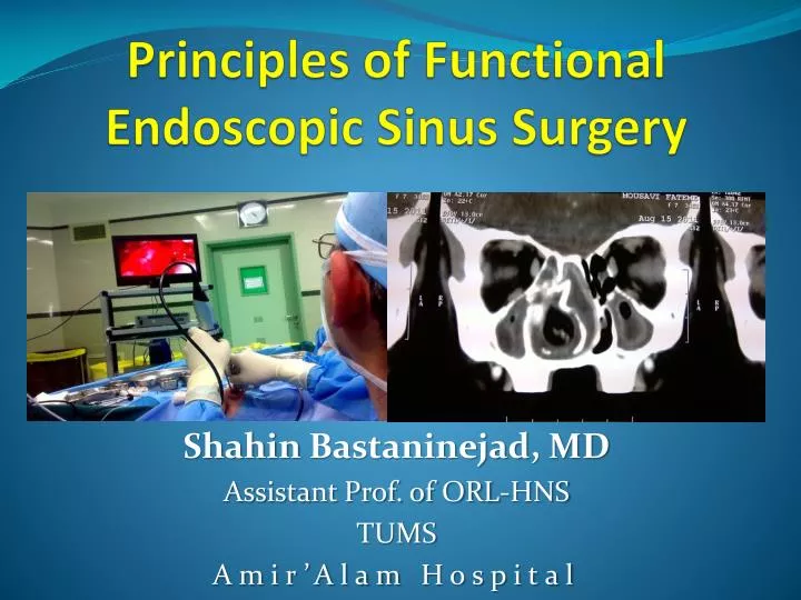 principles of functional endoscopic sinus surgery n.