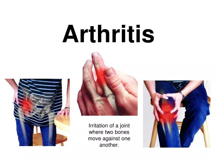 Arthritis Powerpoint Template Free Printable Templates