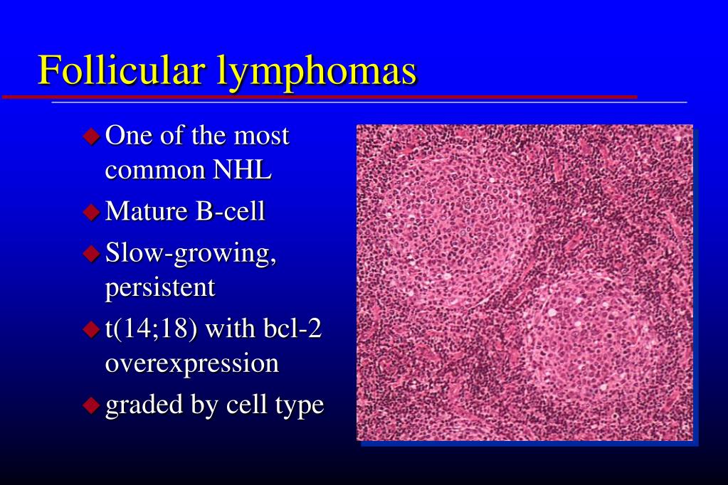 PPT - Malignant Lymphomas PowerPoint Presentation, Free Download - ID ...