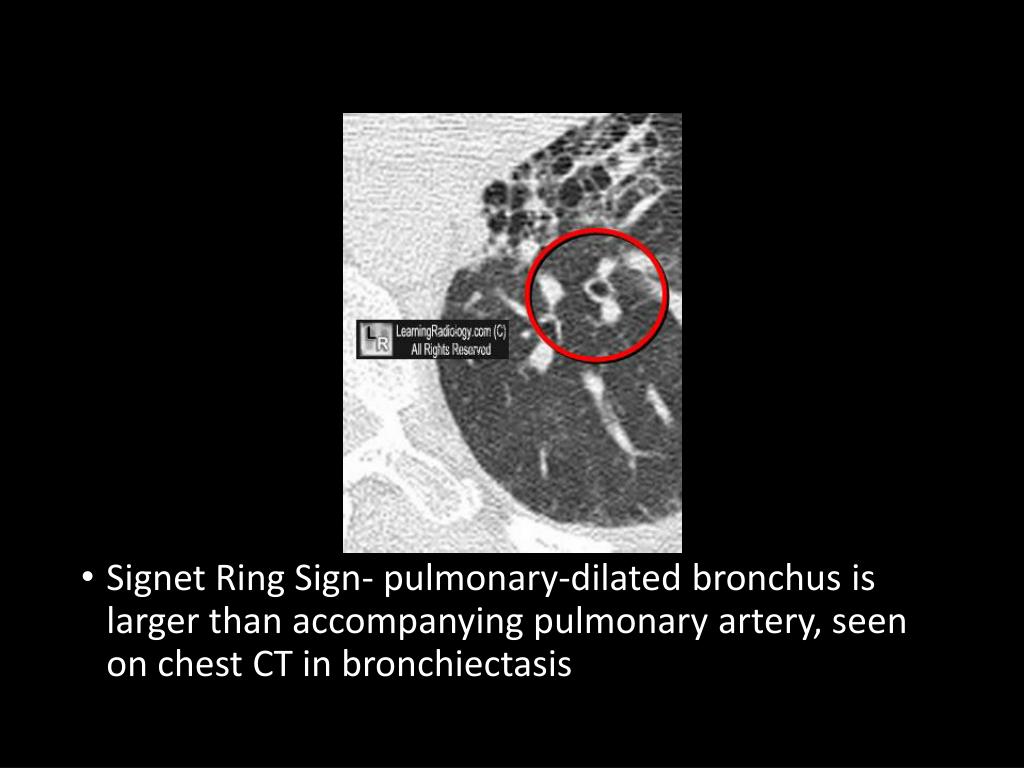 Pathology Outlines - Bronchiectasis