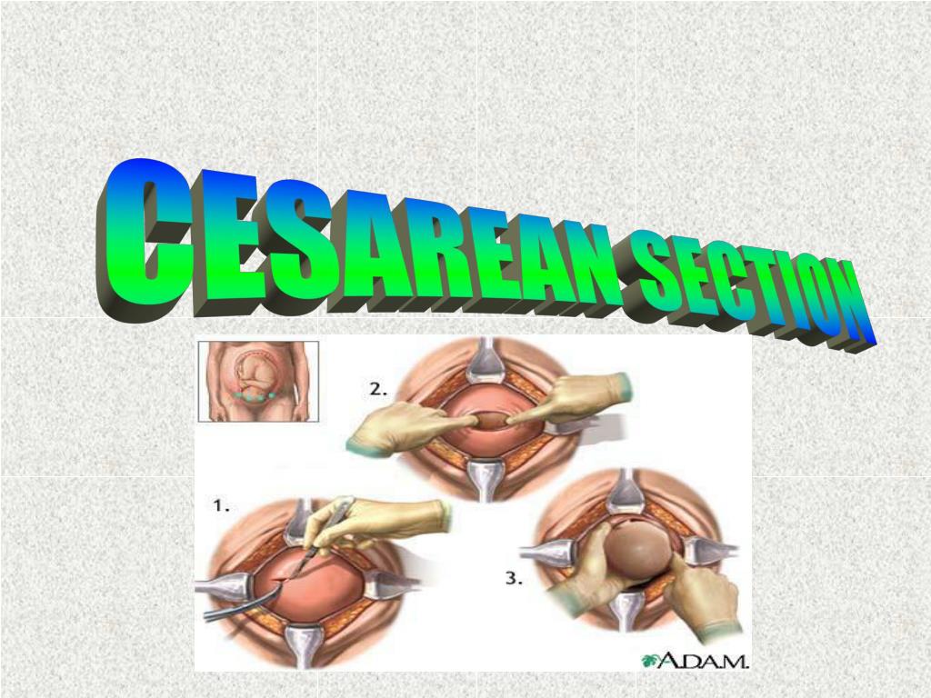 cesarean section case presentation