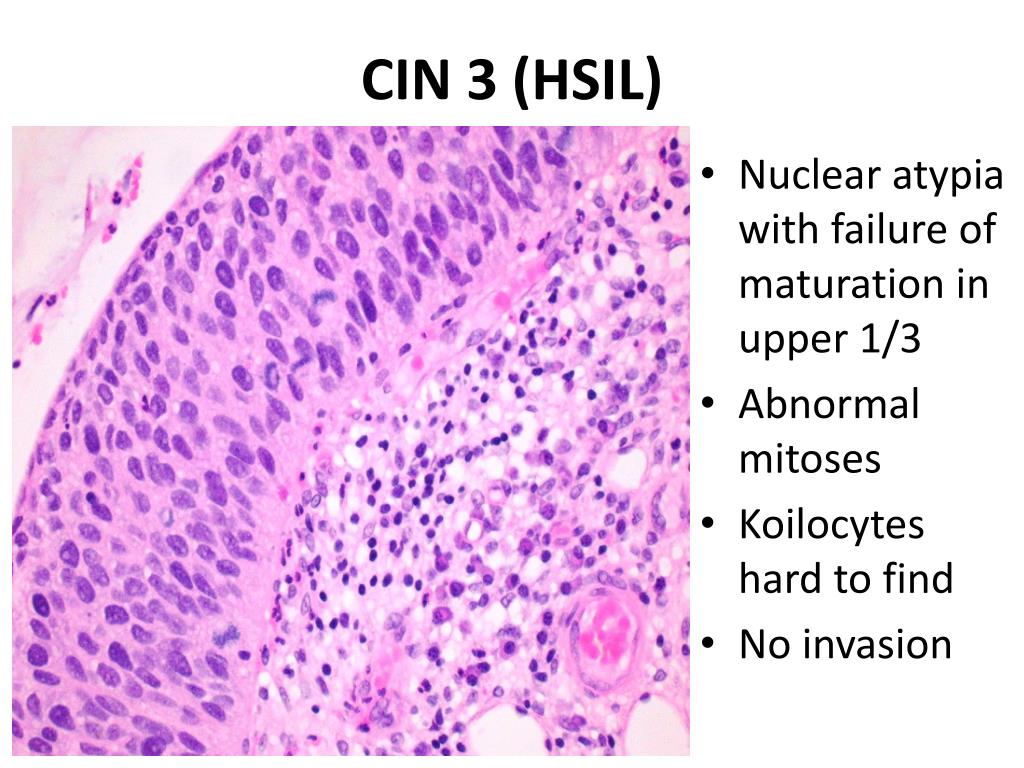 Интраэпителиальное поражение hsil. Дисплазия шейки матки HSIL cin3.