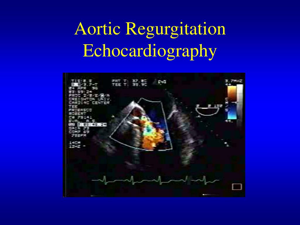 PPT - Aortic Insufficiency Acute and Chronic PowerPoint Presentation ...