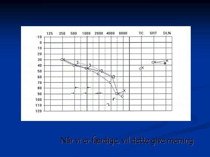perceptivt høretab perceptivt høretab