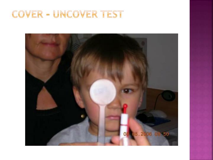 PPT STRABISMUS PowerPoint Presentation ID4244910