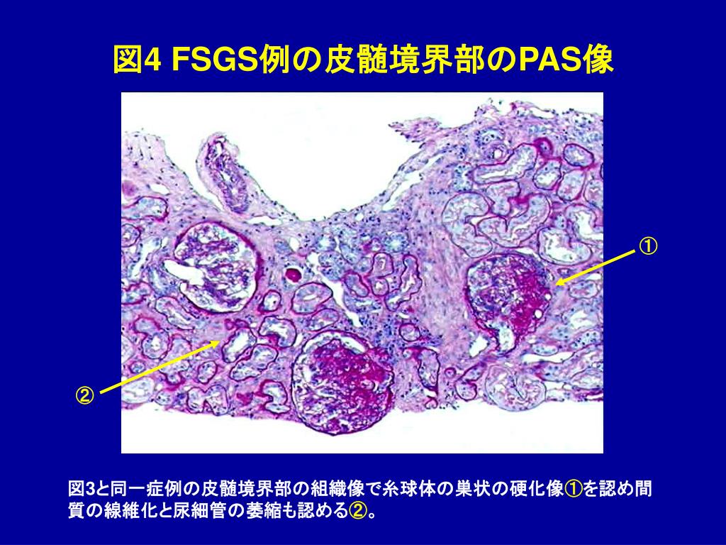 Ppt 図 1 巣状糸球体硬化症 Fsgs Powerpoint Presentation Id Ppt 図 1 巣状糸球体硬化症 Fsgs Powerpoint Presentation Id