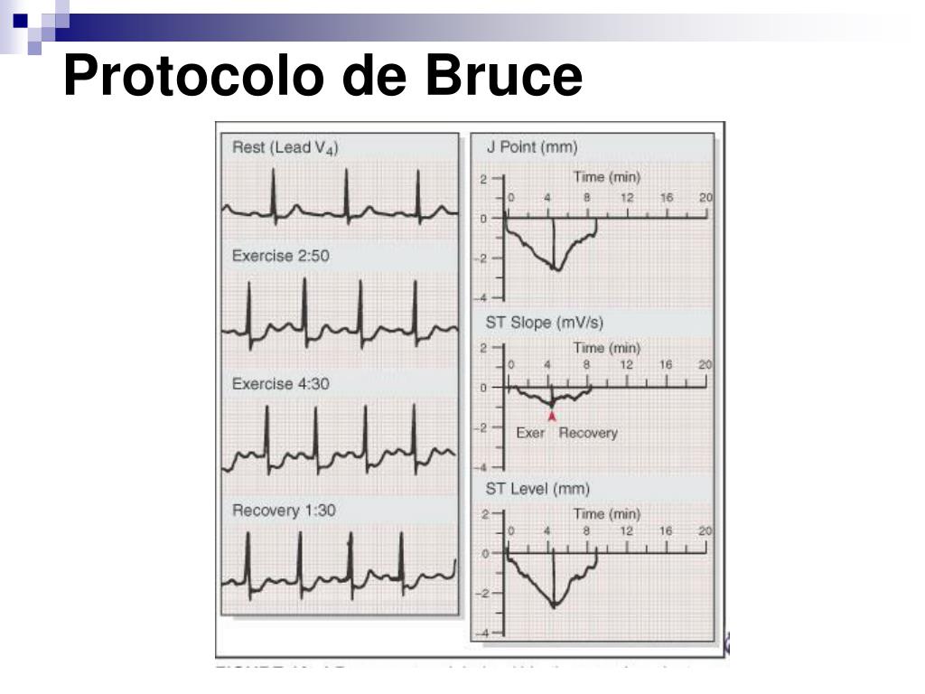 PPT - PRUEBA DE ESFUERZO PowerPoint Presentation, free download - ID ...
