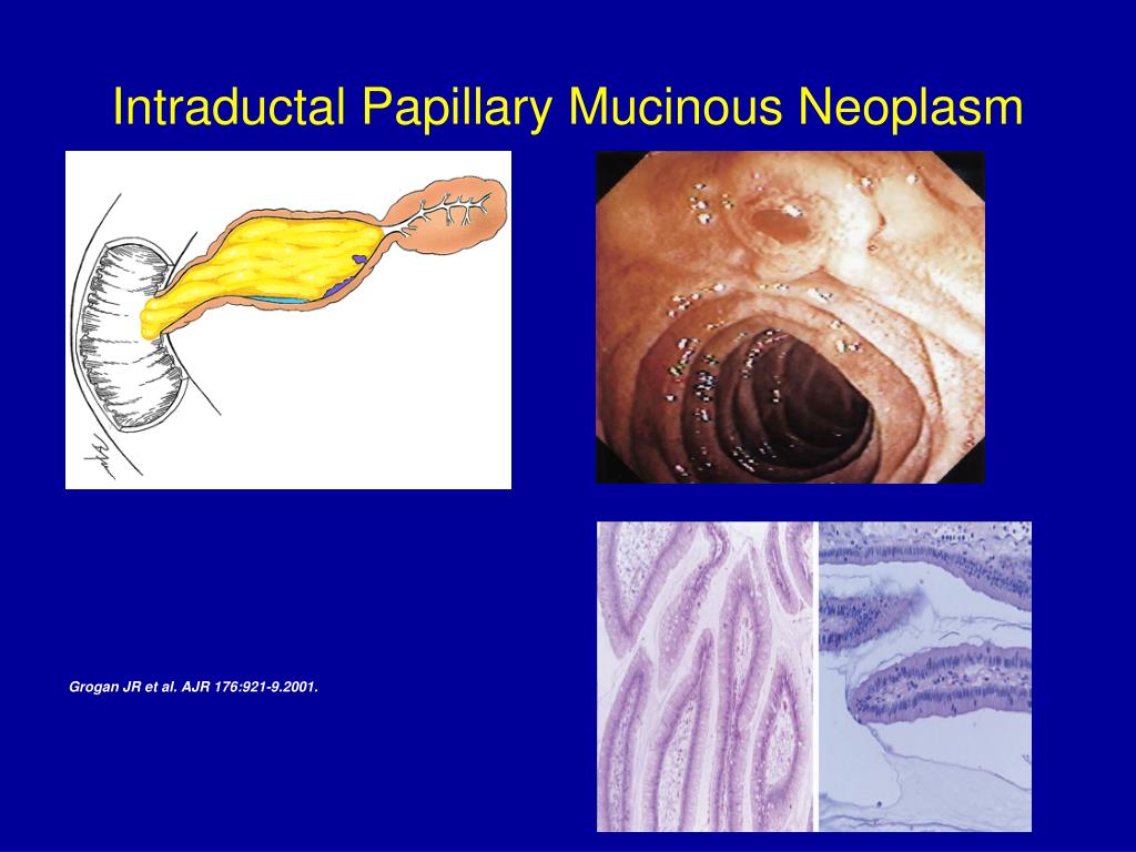 Intraductalis papilláris mucinos neoplazma, Az exokrin hasnyálmirigy daganata