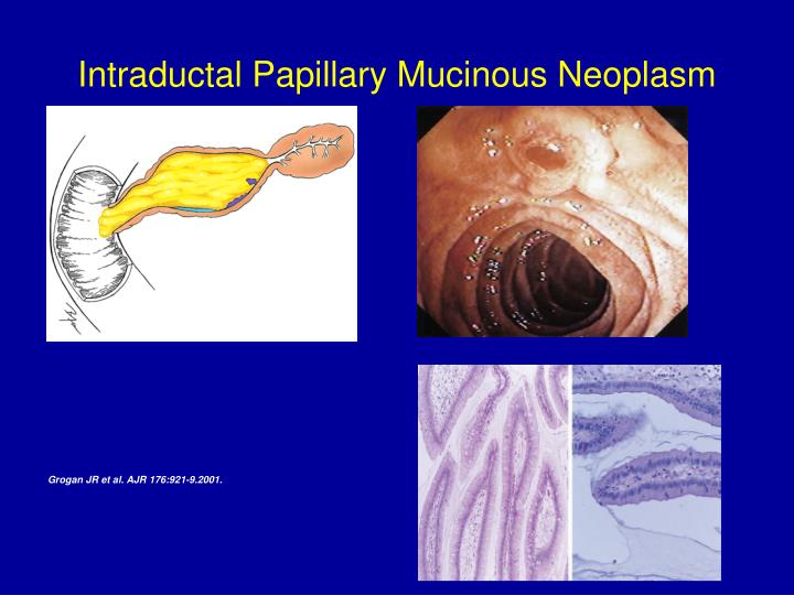 PPT - Intraductal Papillary Mucinous Neoplasms PowerPoint Presentation ...