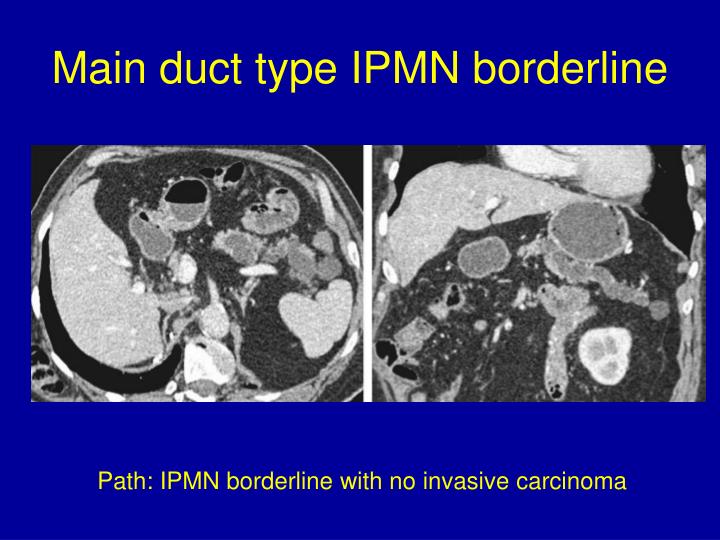 PPT - Intraductal Papillary Mucinous Neoplasms PowerPoint Presentation ...