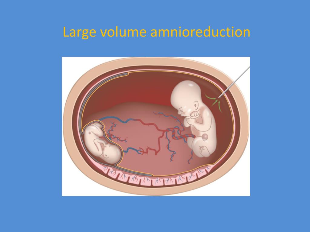 PPT Multifetal Pregnancy PowerPoint Presentation, free download ID