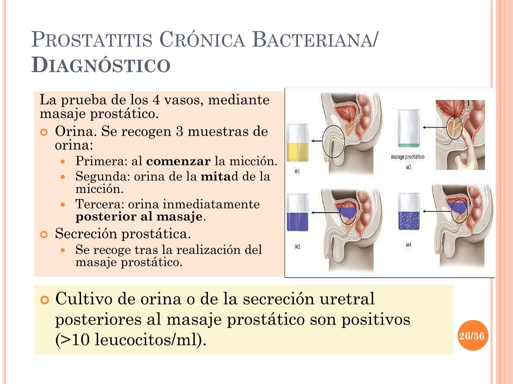 prostatitis cronica ppt