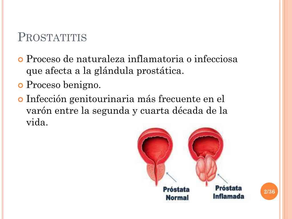 Prostatitis hogyan jön ki