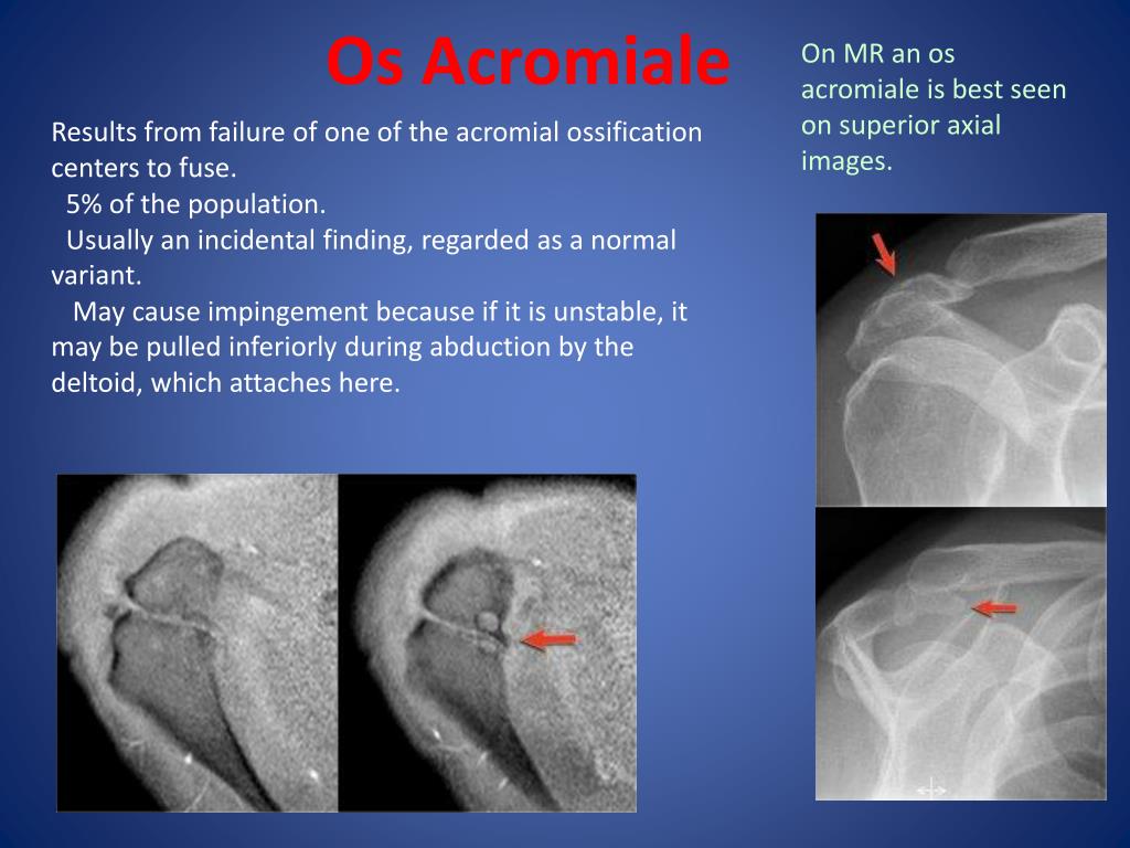 PPT MRI Anatomy of the Shoulder PowerPoint Presentation 