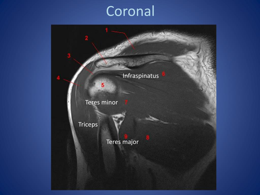 PPT - MRI Anatomy of the Shoulder PowerPoint Presentation, free