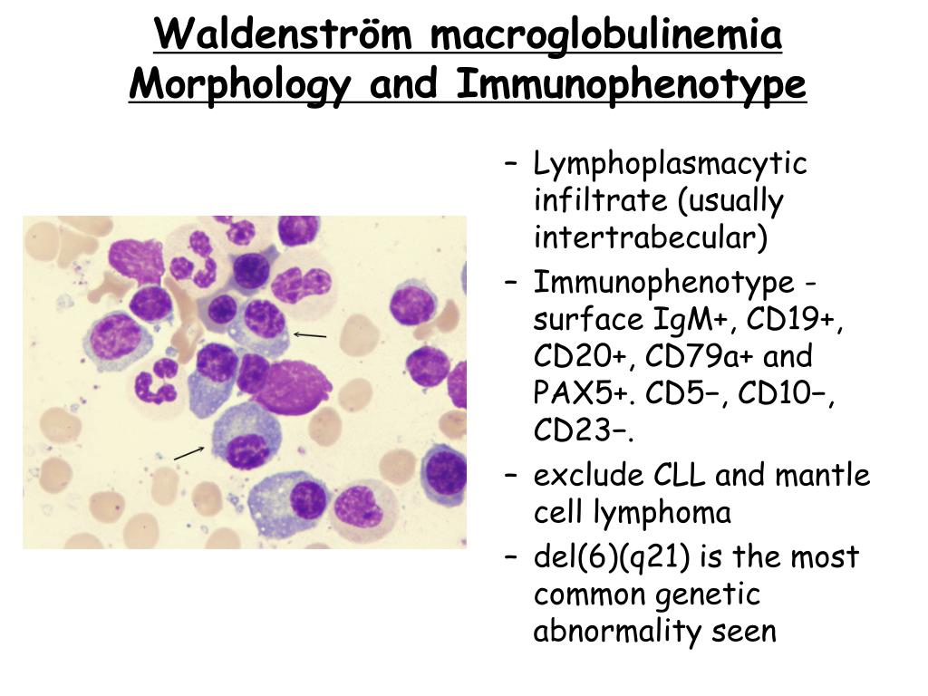 Ppt Waldenström Macroglobulinemia Powerpoint Presentation Free