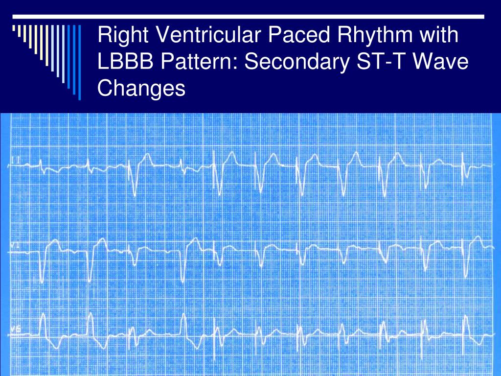 PPT Diagnosis Of Myocardial Infarction Ischemia With Bundle Branch 