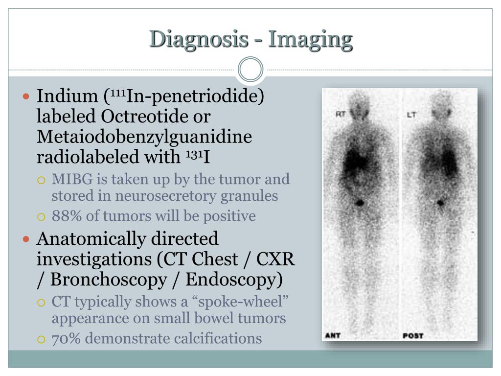 Positive Indium Scan PPT - Diagnosis & Surgical Management of Carcinoid Tumors PowerPoint ...