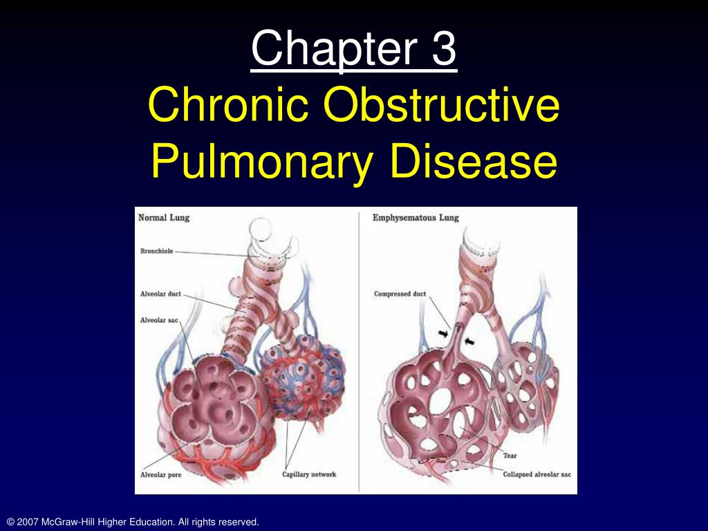 Ppt Chapter 3 Chronic Obstructive Pulmonary Disease Powerpoint Presentation Id4286492