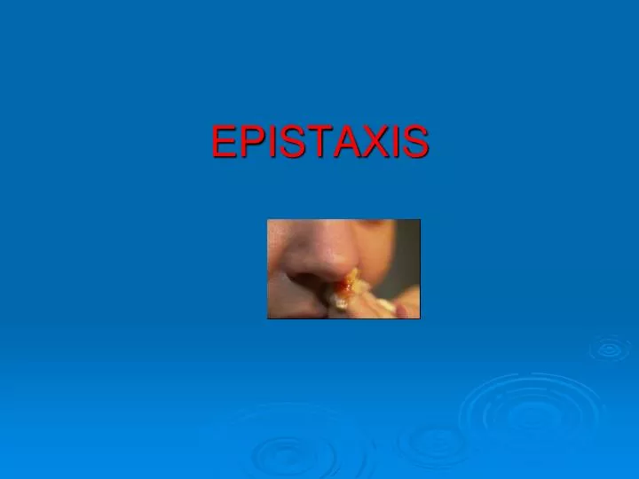 epistaxis by n.